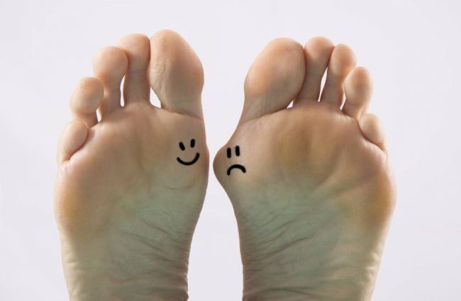 bunion-surgery-is-keyhole-or-open-the-better-option-pure-physio